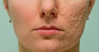 Brush This Mixture in Scars, Wrinkles and Spots and Enjoy The Results